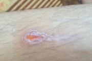 发黄结痂（探索发黄结痂的起因、症状和治疗方法）