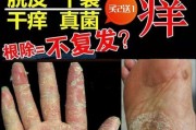 真菌感染的治疗药物及应用（探索真菌感染的药物治疗方法，帮助患者重获健康）