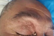 探究以眼睛长息肉的成因与治疗方法（解析息肉形成的原因和有效的治疗方案）