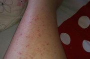 身上腿上红疙瘩结痂的原因和治疗方法（了解红疙瘩结痂的形成过程及有效的治疗方案）