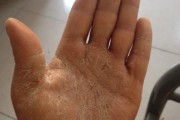 鼻孔裂口的原因及预防方法（探索鼻孔裂口背后的原因与预防措施）